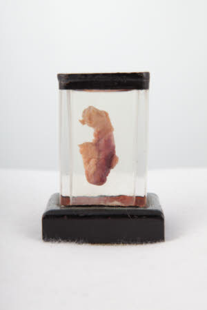 Appendix floating in a glass box.